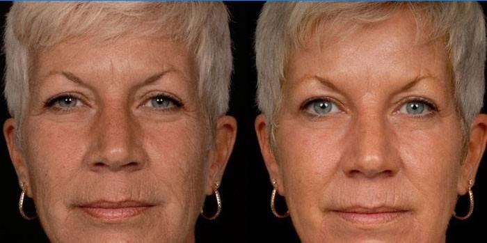 Foto naisest enne ja pärast karboksüteraapiat