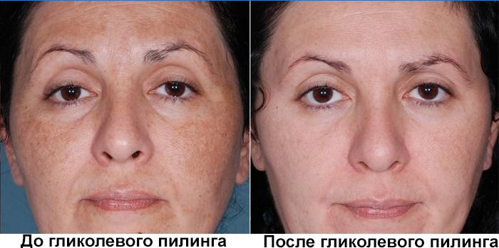 Nägu enne ja pärast glükoolkoorimist