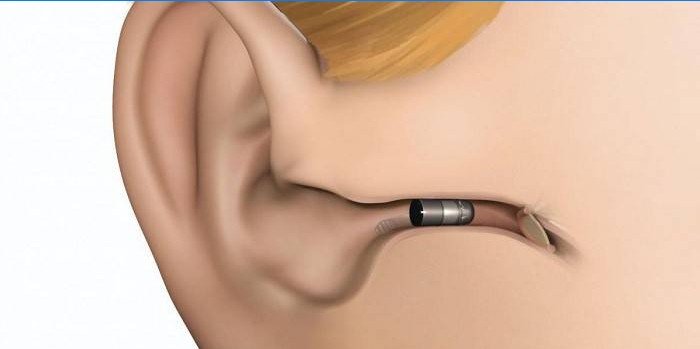 Kõrvasisese kuuldeaparaadi paigutus