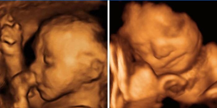 Poisi ja tüdruku ultraheli 25 rasedusnädalal