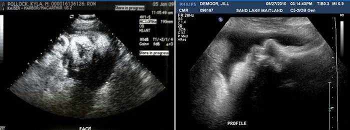 Ultraheli 38 rasedusnädalal